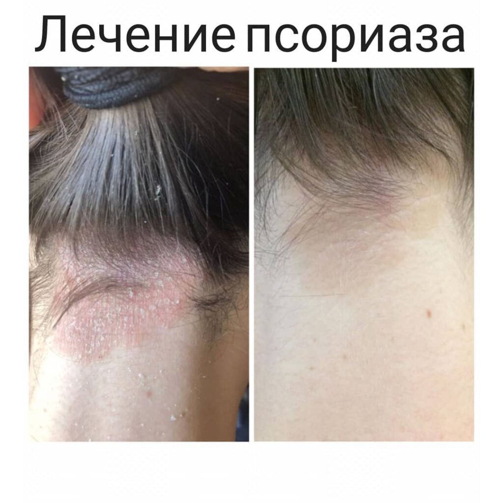 LeSeNiee ofatopiчeskogogo dermatiota ypsor 